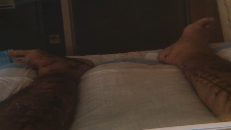 Lakewood Ranch resident shares his story surviving Vibrio vulnificus